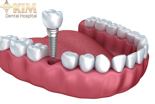  Phẫu thuật trồng răng implant có đau không 1