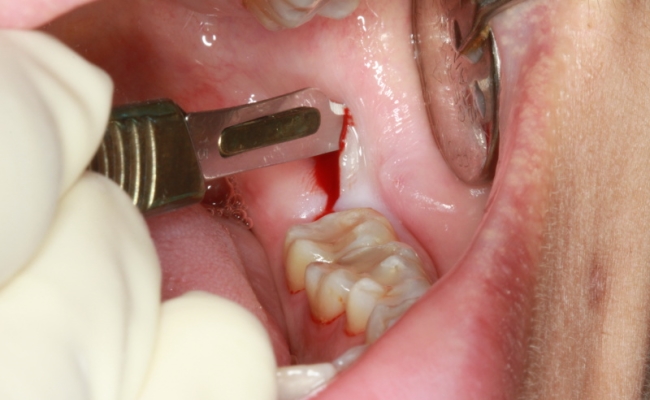 Nhổ răng hàm có đau không,cách nhổ răng hàm không đau