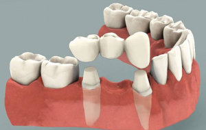 Phương pháp trồng răng giả cố định nào là cách phục hình tốt nhất