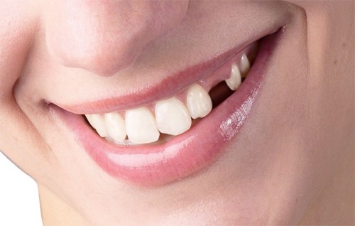 Bị mất răng phải làm sao và nên trồng răng theo cách nào thì tốt nhất1