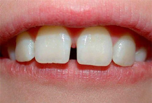 Răng thưa có nên niềng răng không -Chuyên gia giải đáp