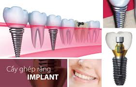 Những tiêu chí đánh giá địa chỉ trồng răng Implant ở đâu tốt?
