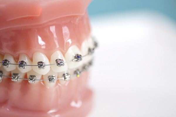 Cách rút ngắn thời gian niềng răng thưa an toàn hiệu quả vẫn không thay đổi 1