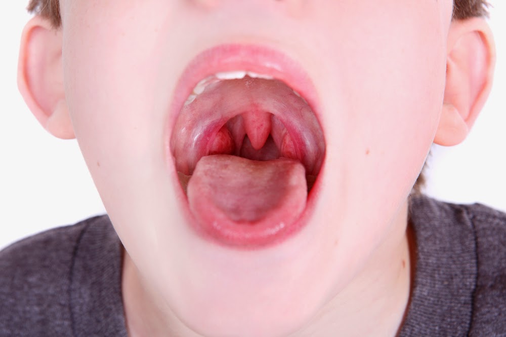 Nguyên nhân viêm họng ở trẻ em và biến chứng có thể gặp phải? 1