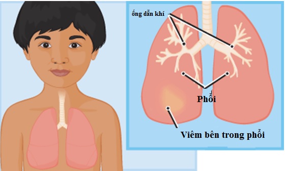 Viêm phổi là gì, triệu chứng viêm phổi ở trẻ em như thế nào? 1