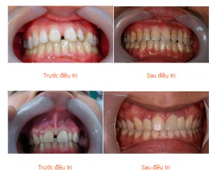 Cách chỉnh răng thưa nào đem lại hiệu quả cao nhất hiện nay?