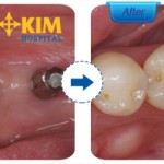 Mất răng cấm thì có nguy hiểm và ảnh hưởng gì về sau không?