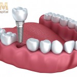 Phẫu thuật trồng răng implant có đau không