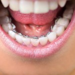 Niềng răng mặt trong hiệu quả nhất tại Nha khoa Kim