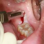 Quy trình nhổ răng khôn an toàn là như thế nào?