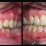 Niềng 2 răng cửa bị lệch bao lâu thì hiệu quả ?