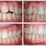 Niềng răng Invisalign tại Hà Nội ở đâu uy tín nhất hiện nay?