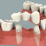 Phương pháp trồng răng giả cố định nào là cách phục hình tốt nhất