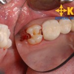 Mất răng số 7 có nên làm răng mới và áp dụng phương pháp nào?