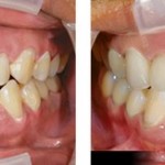 Nhổ răng cửa hàm trên có nguy hiểm không  – Bác sỹ tư vấn