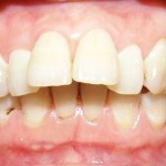 Phương pháp chỉnh răng cửa bị hô hiệu quả nhất