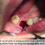 Nhổ răng sâu sớm có đau không?
