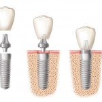 Phương pháp làm răng giả vĩnh viễn implant mới nhất hiện nay