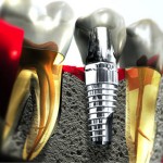 Giải đáp thắc mắc cấy ghép răng implant là gì? – Dành cho người mất răng