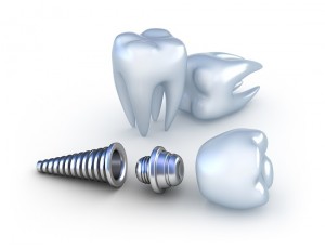 Chế độ chăm sóc răng implant tốt dành cho người mới làm răng