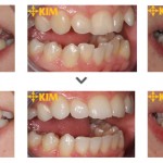 Quy trình niềng răng cho kết quả bất ngờ, đẹp hoàn hảo?