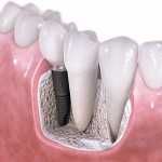 Trồng răng thẩm mỹ phương pháp tốt nhất hiện nay tại nha khoa