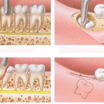 Những BIẾN CHỨNG sau khi nhổ răng KHÔN và cách điều trị