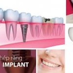 Những tiêu chí đánh giá địa chỉ trồng răng Implant ở đâu tốt?