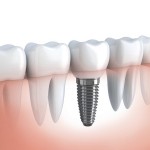 Quy trình trồng răng implant đạt tiêu chuẩn tại nha khoa hiện nay