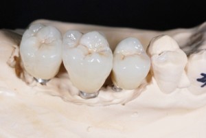 Lợi ích trồng răng sứ mang lại cho người làm răng mới