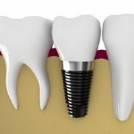 Chi tiết bảng giá làm răng implant tại nha khoa tốt nhất hiện nay