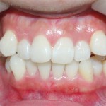 HOT – Chỉnh răng mọc lệch không cần phải nhổ răng