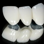 Quy trình trồng răng sứ mới nhất đạt chuẩn từ nha khoa