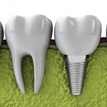 Tìm hiểu trồng răng implant 4s hiện đại nhất tại nha khoa