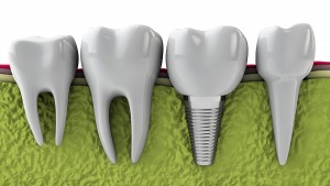 Tìm hiểu trồng răng implant 4s hiện đại nhất tại nha khoa