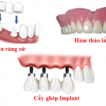 Lưu ý khi trồng răng implant tốt dành cho người bị mất răng