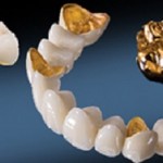 Hai cách trồng răng sứ tốt nhất nên biết dành cho người mất răng