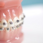 Cách rút ngắn thời gian niềng răng thưa an toàn hiệu quả vẫn không thay đổi