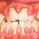 Chăm sóc nha chu để bảo vệ răng miệng chắc khỏe