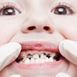 Điều trị viêm tủy răng ở trẻ em