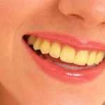 Cách làm trắng răng bị ố vàng CỰC KÌ hiệu quả ngay tại nhà