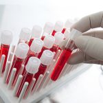 Xét nghiệm máu mất bao lâu thì có kết quả – Phòng khám đa khoa Pacific