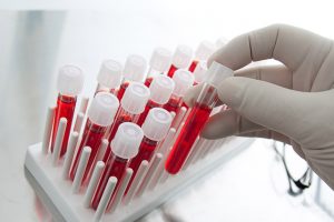 Xét nghiệm máu mất bao lâu thì có kết quả – Phòng khám đa khoa Pacific