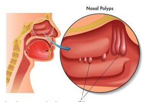 Mách bạn cách điều trị Polyp mũi an toàn hiệu quả nhất hiện nay